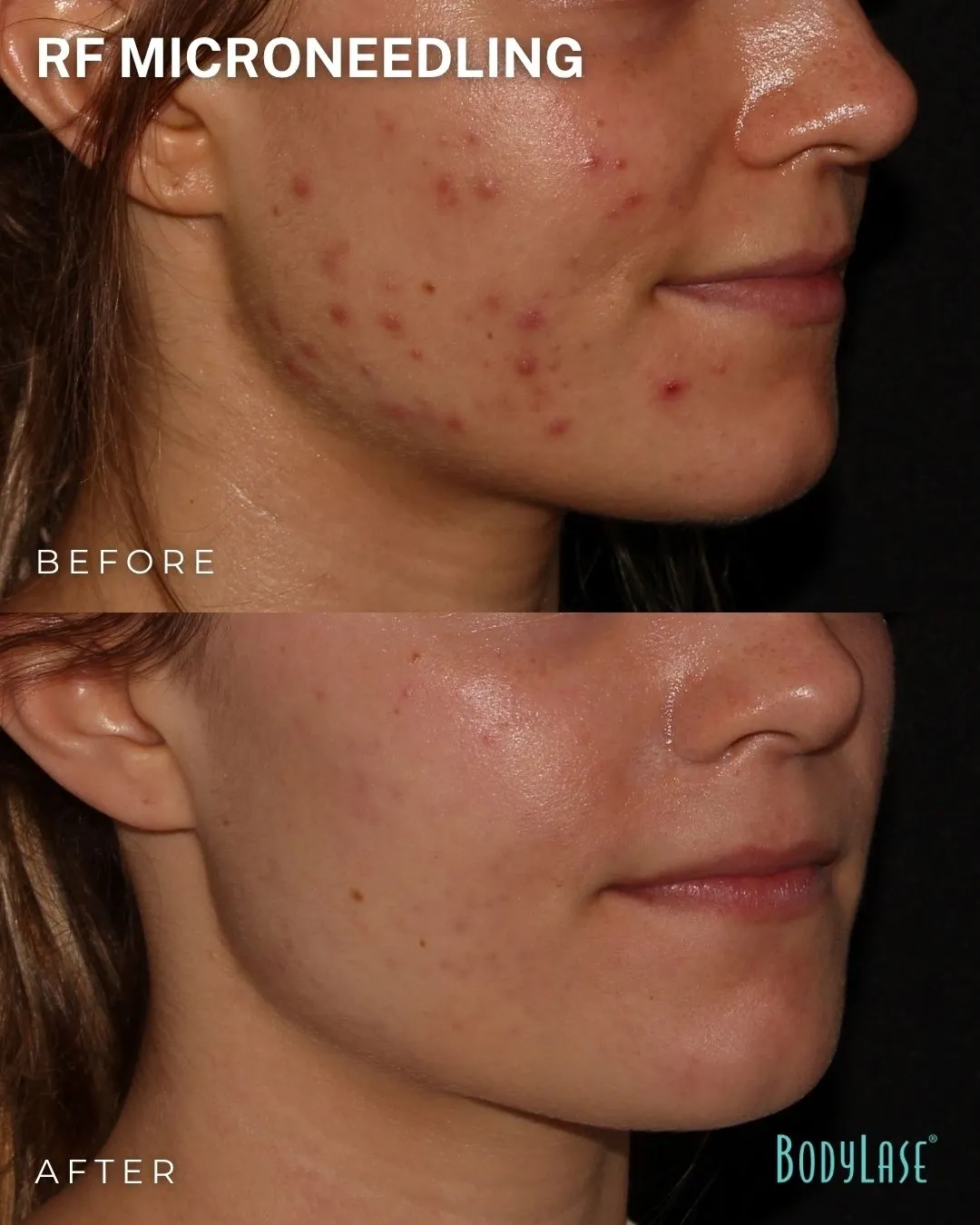 RF microneedling before and after result 2