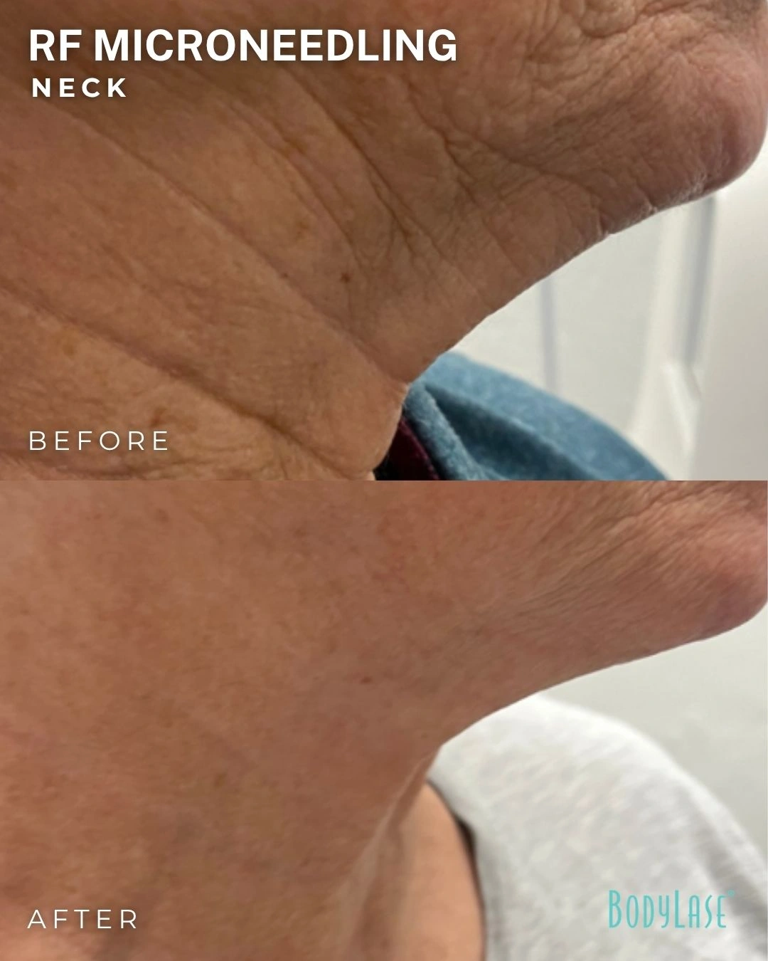 RF microneedling before and after result 1