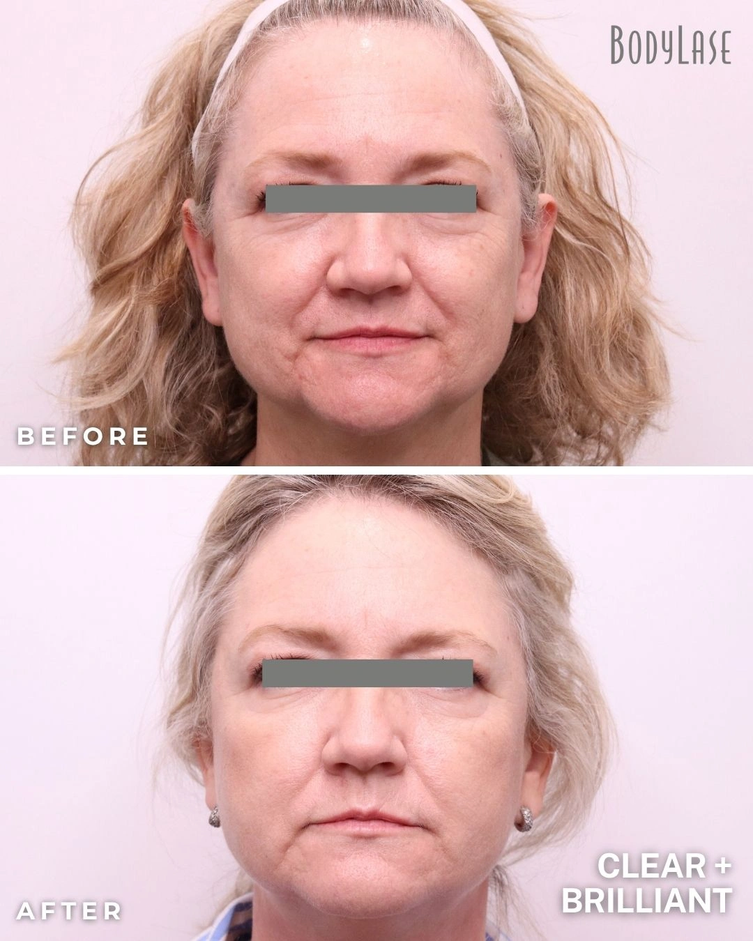 Clear + Brilliant before and after result 3