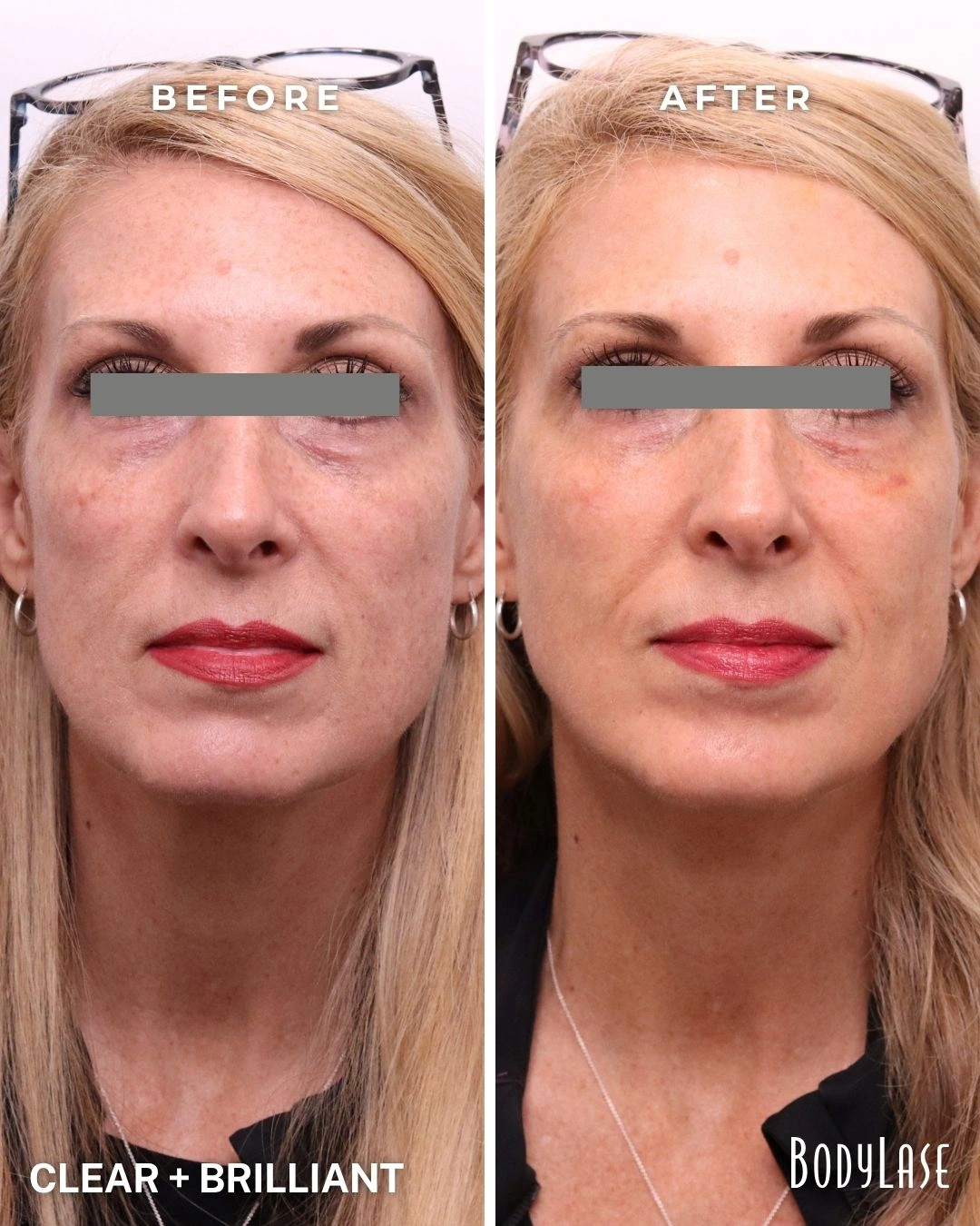 Clear + Brilliant before and after result 2