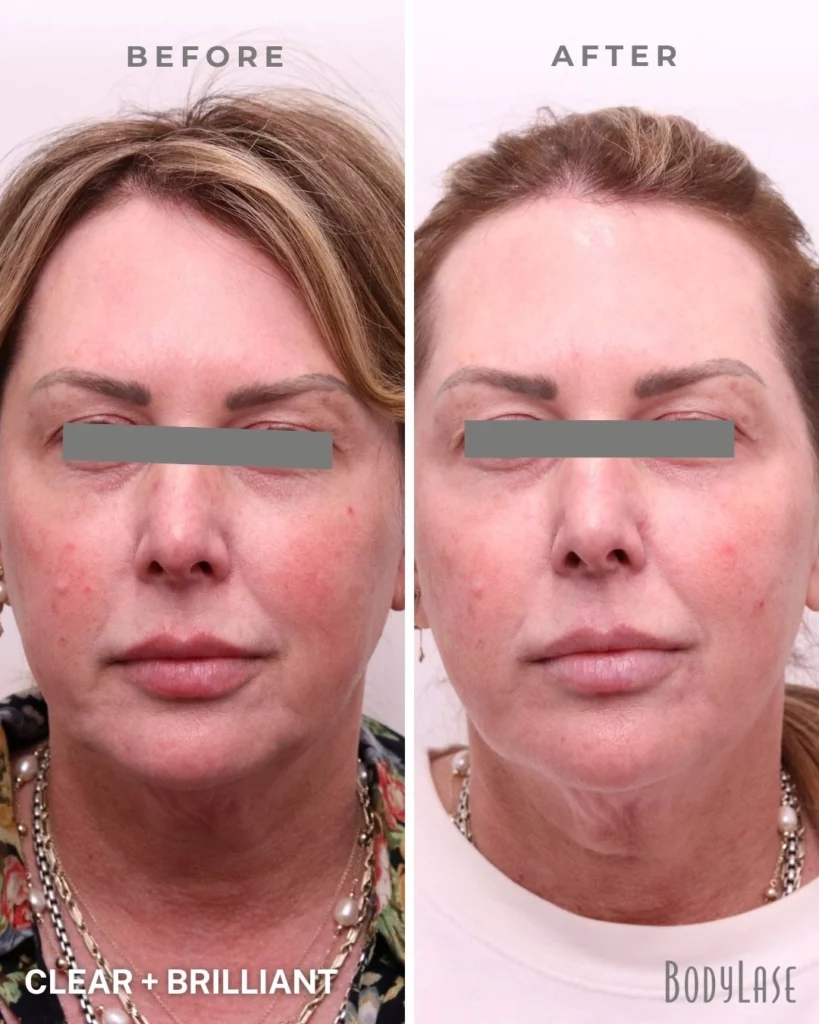 BodyLase® Med Spa - clear brilliant 40