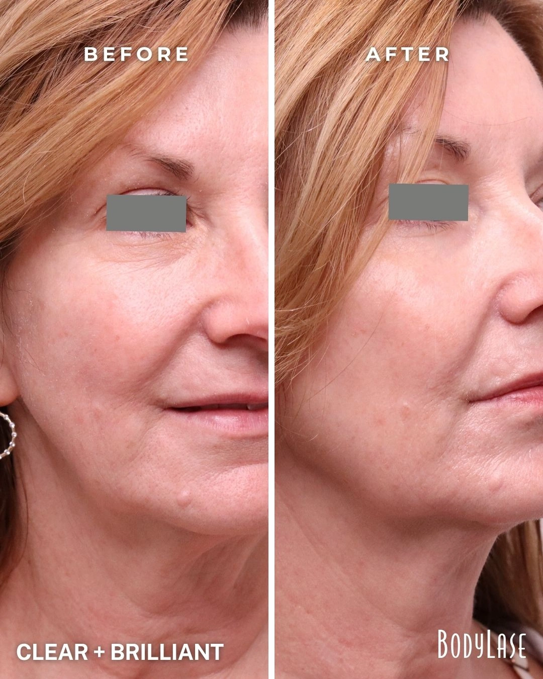 Clear + Brilliant before and after result 1
