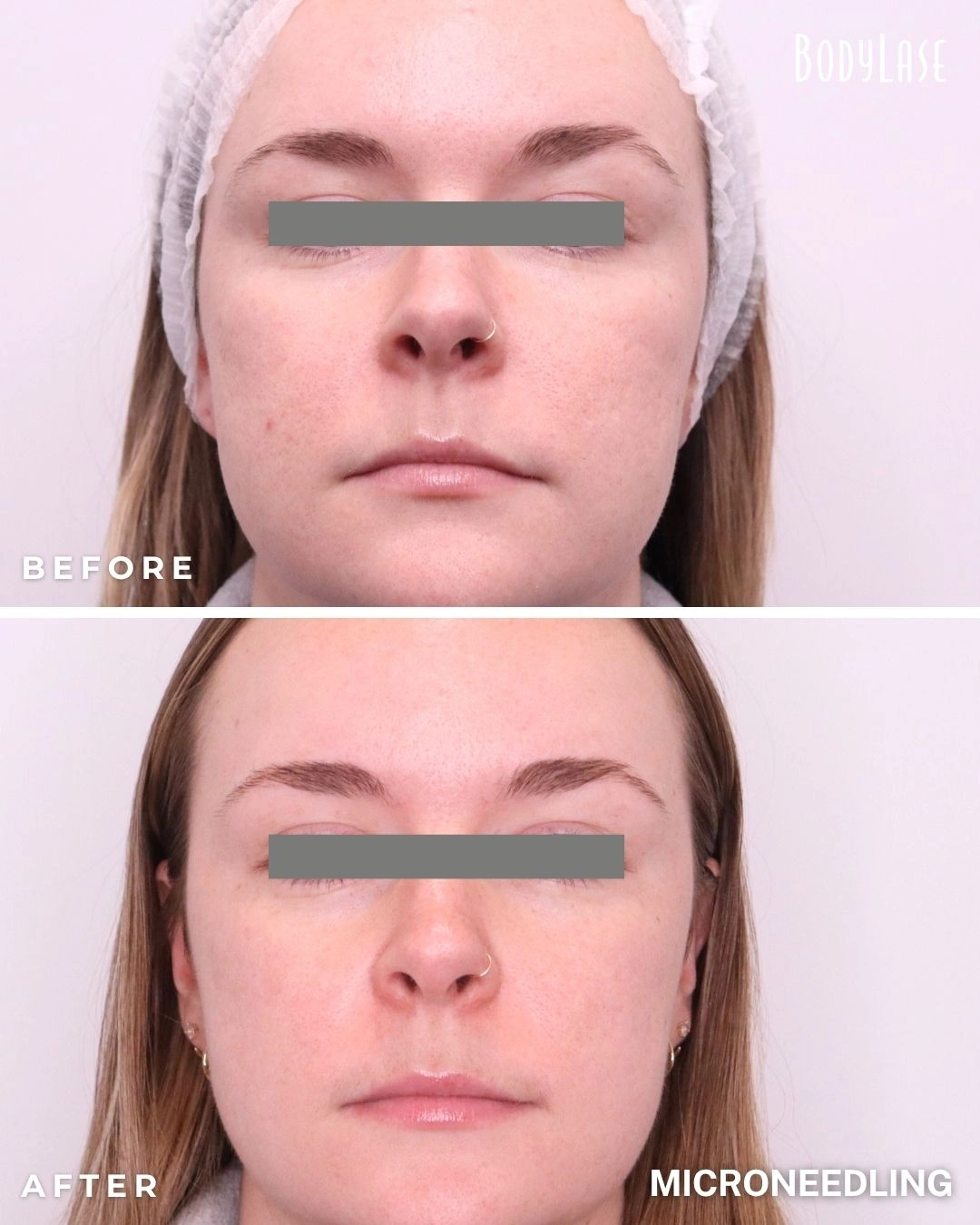 RF microneedling before and after result 3