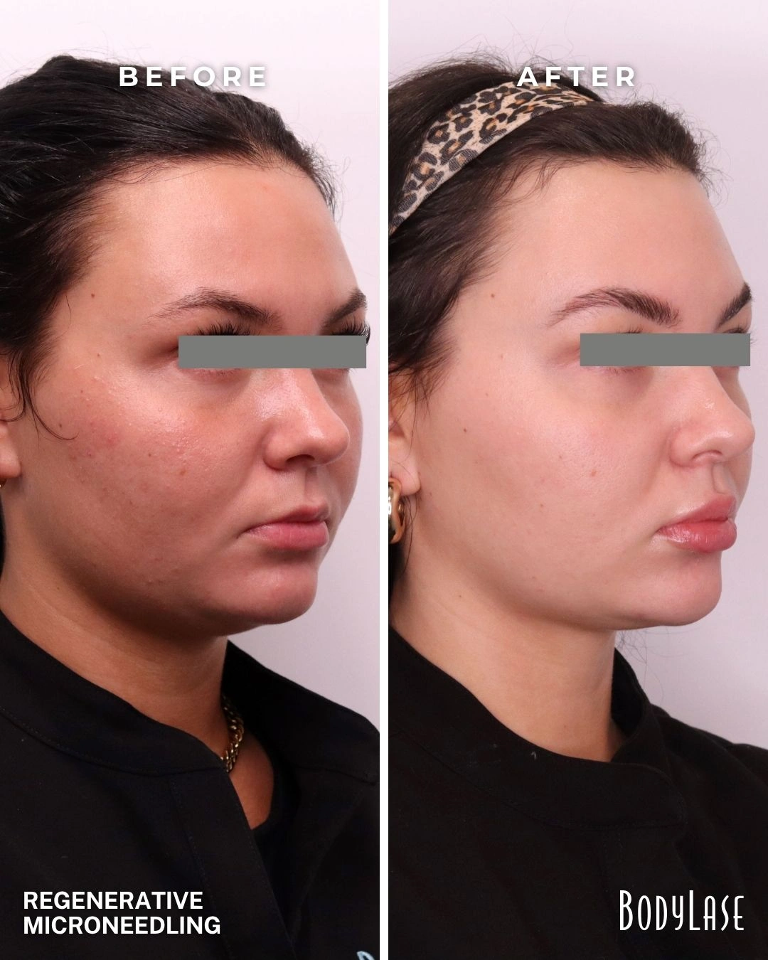 RF microneedling before and after result 2