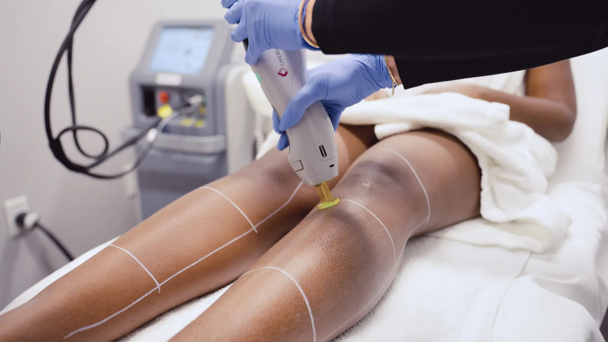 BodyLase® Med Spa - BodyLase Cool Summer Consultation BOGO 50 Off Laser Hair Removal scaled