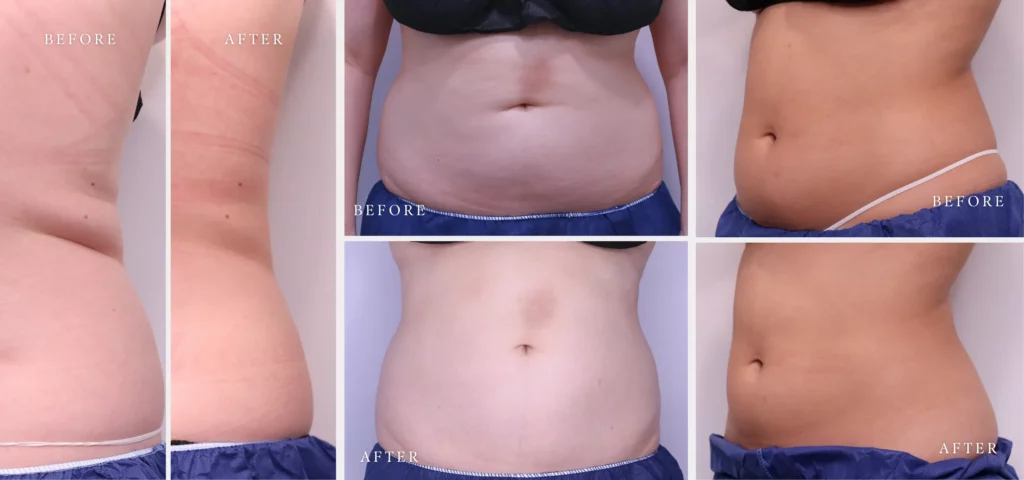 BodyLase® Med Spa - BodyLase Cool Summer Consultation Featured Image CoolSculpting Services
