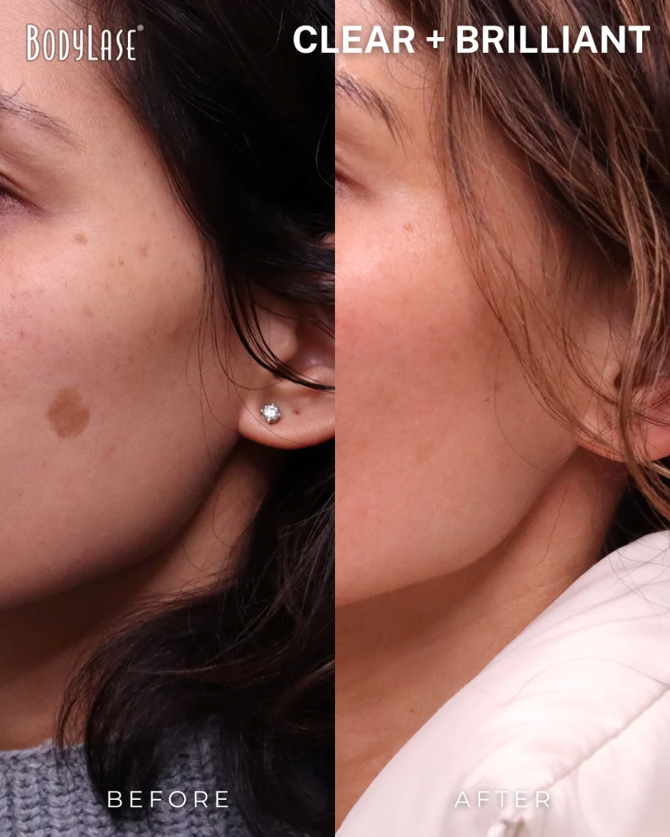 Clear + Brilliant before and after result 1