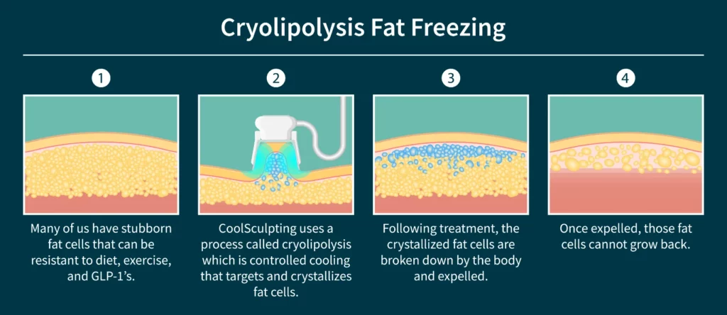 BodyLase® Med Spa - CoolSculpting Diagram BodyLase fat freezing 1