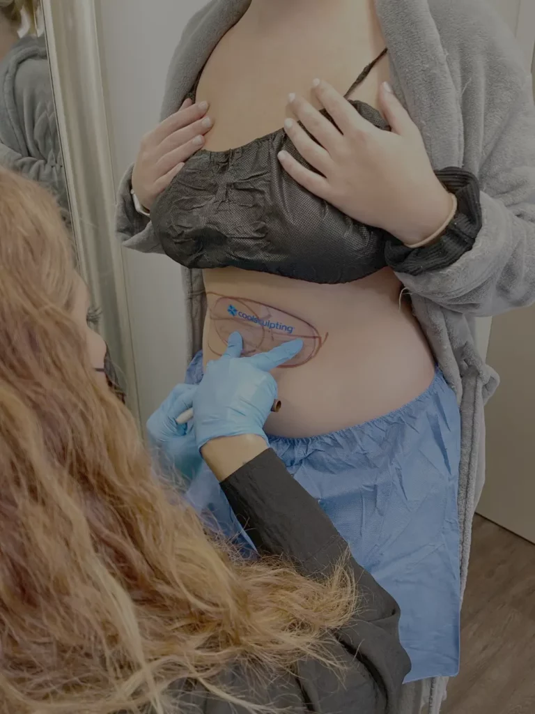BodyLase® Med Spa - CoolSculpting Tummy Placement