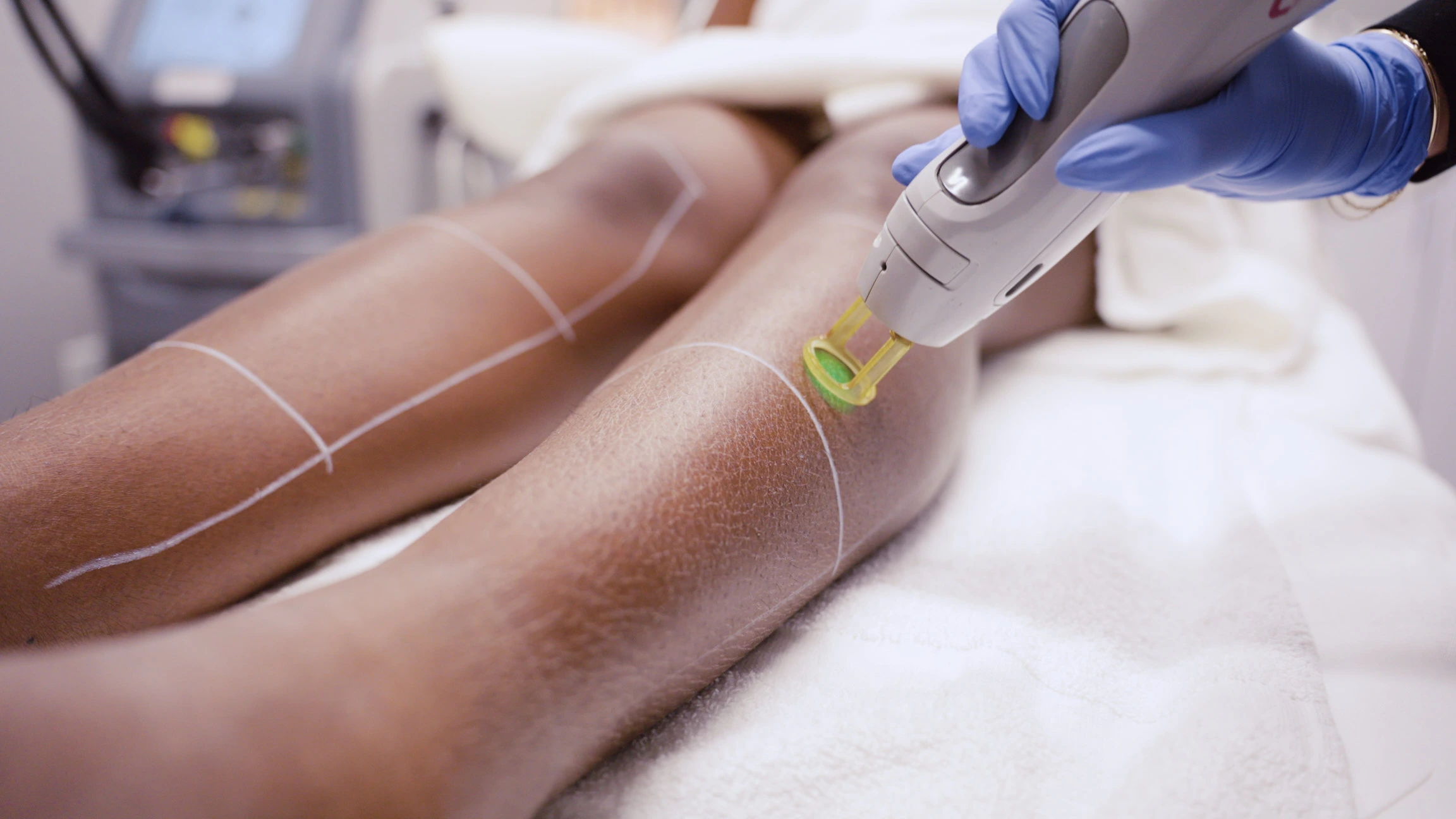 BodyLase® Med Spa - Laser Hair Removal Darker Skin 4